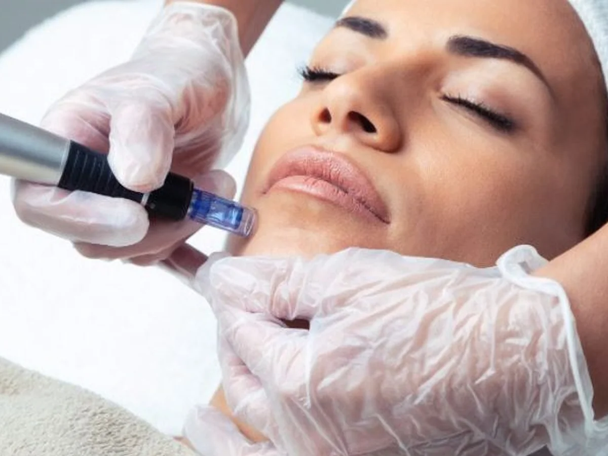 Dermapen y mesoterapia facial en Esencia Estética Campo Real