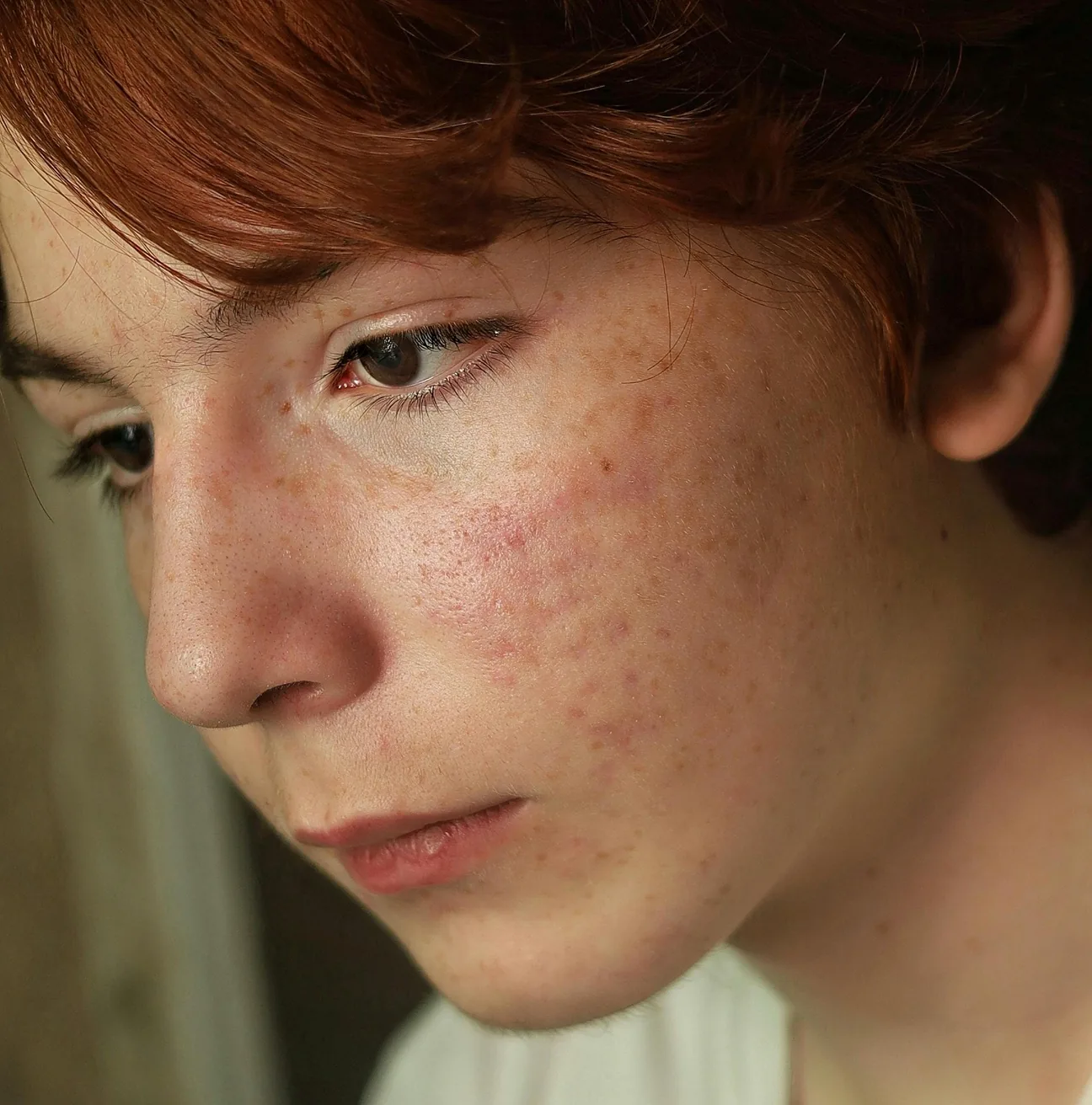 Sensitive skin and rosacea
